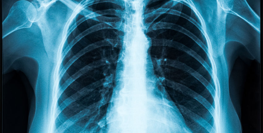 Image of a chest x-ray