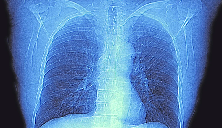 Computed tomography (CT) scan of the chest of an healthy adult, showing normal lungs