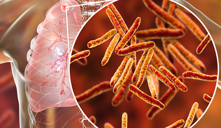 secondary tb in lung and close-up of tb bacteria